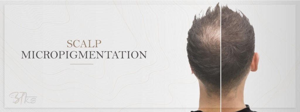 Aks Clinic – Your Premier Destination for Scalp Micropigmentation for Hair Loss in Gurgaon
